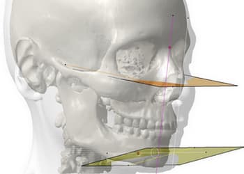 Ejemplo de planificación quirúrgica